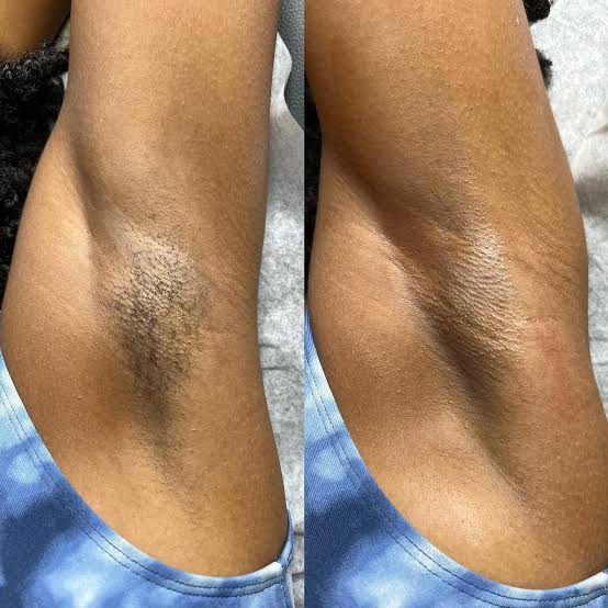 Before and After Waxing 4